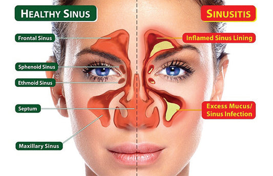 Sinus Health Naturally