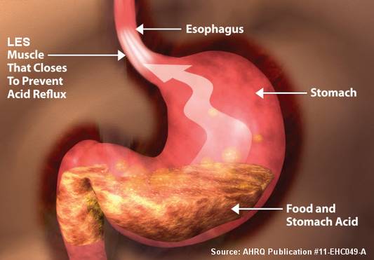 GastroEsophageal Reflux RELIEF
