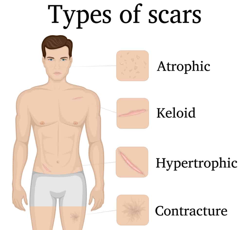 Scar/Adhesion Prevention WOUND and Surgical Site Health