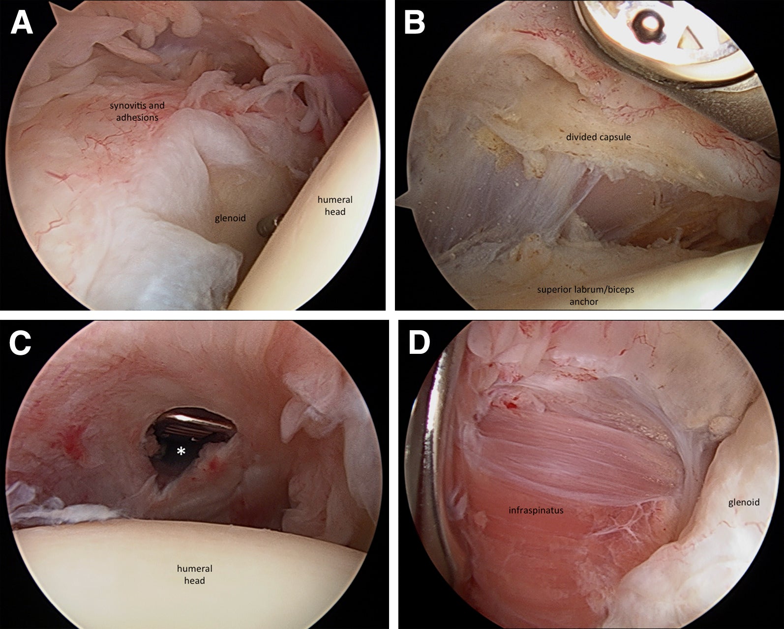 Scar/Adhesion Prevention WOUND and Surgical Site Health